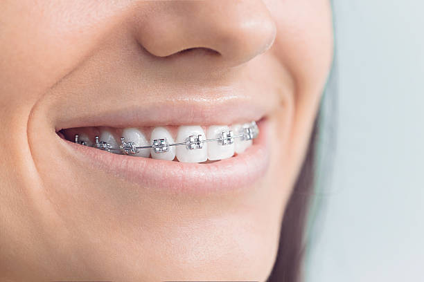 Best Traditional Braces  in Appleton, MN